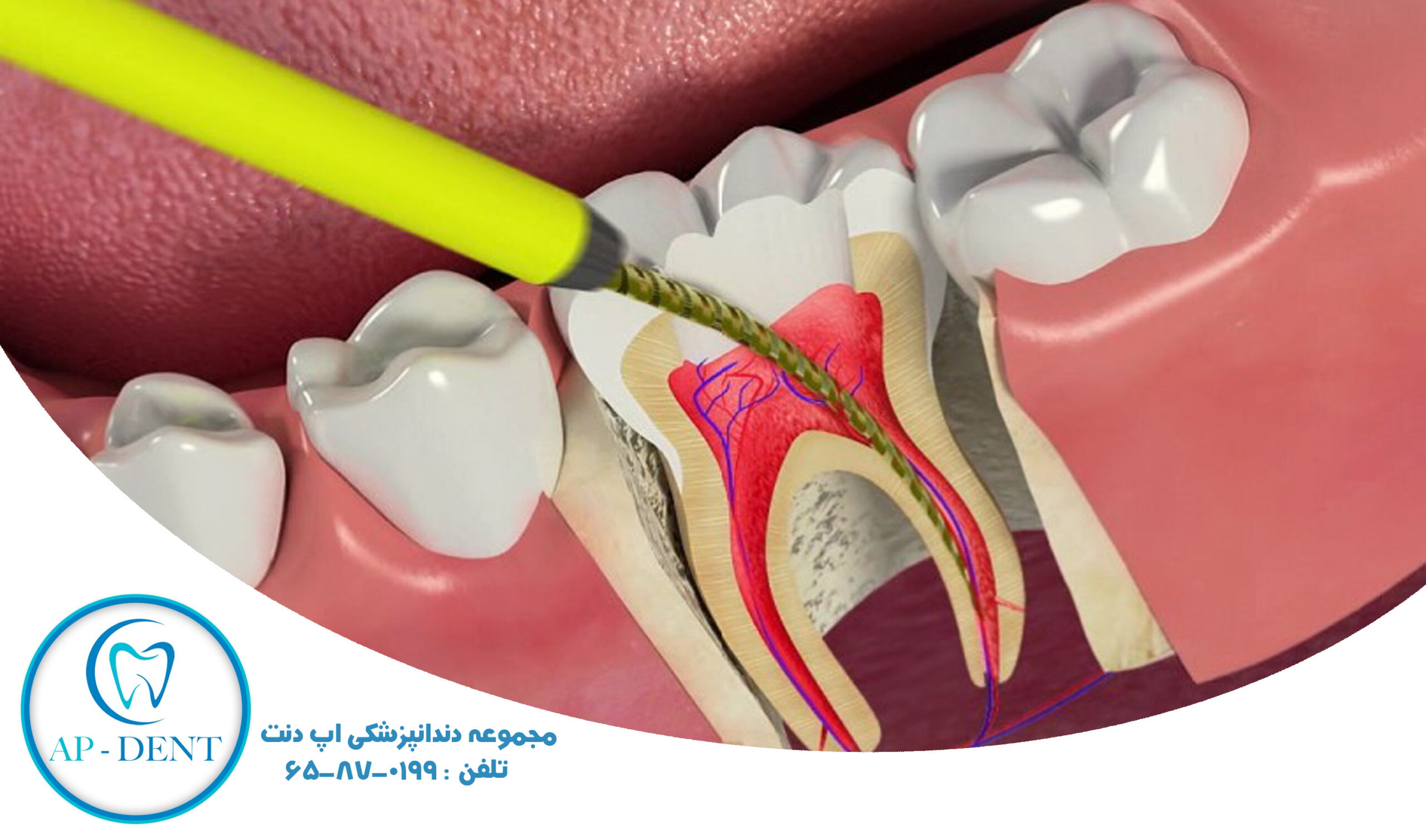 <strong>درمان ریشه دندان با دستگاه اندو روتاری و تجهیزات مرتبط با آن  </strong>