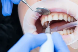 بهترین دستگاه جرمگیری در دندانپزشکی چیست؟